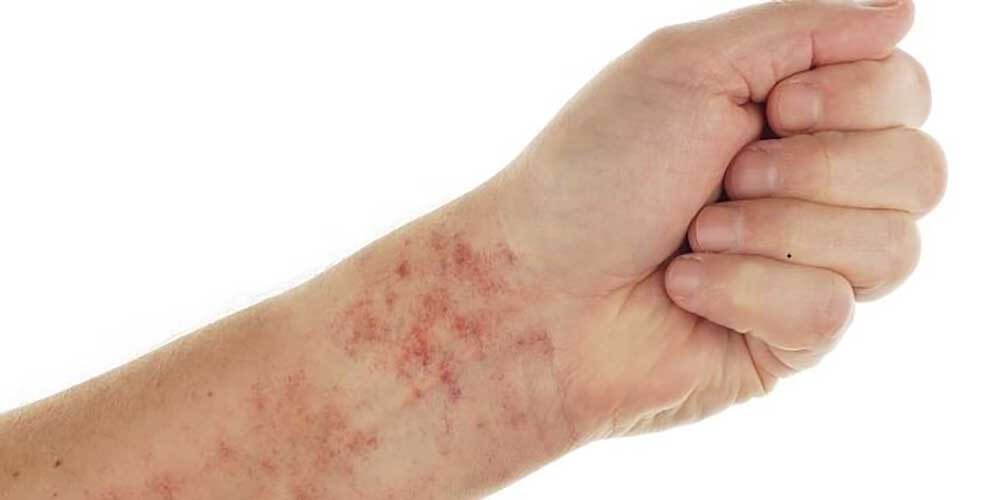 Skin Rash and Sexually Transmitted Diseases: Symptoms, Types, and