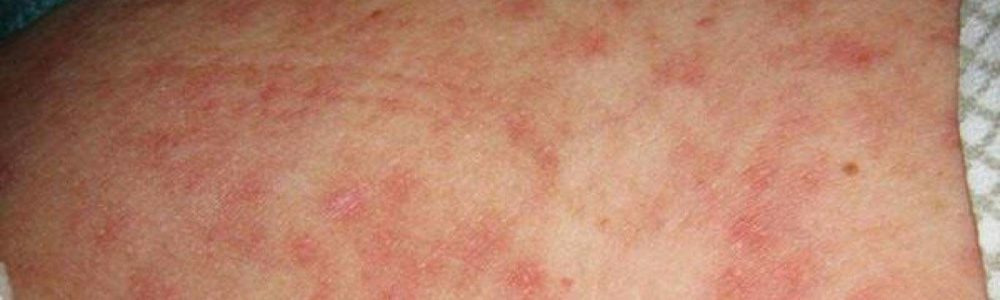 Skin Rash and Sexually Transmitted Diseases: Symptoms, Types, and  Differentiation