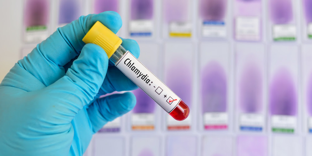 test-options-for-chlamydia-patients