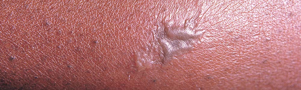 gonorrhea symptoms skin
