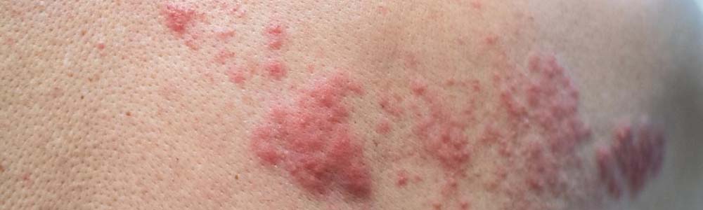 Is your skin rash an STD rash?. Any change in the genital area