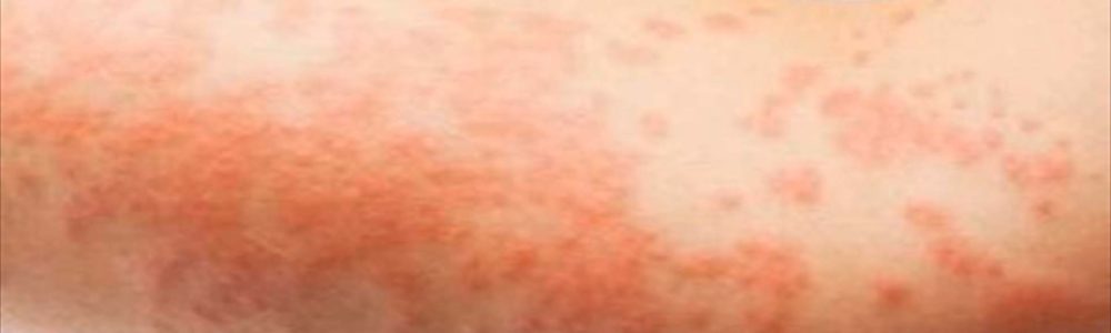 Skin Rash And Sexually Transmitted Diseases