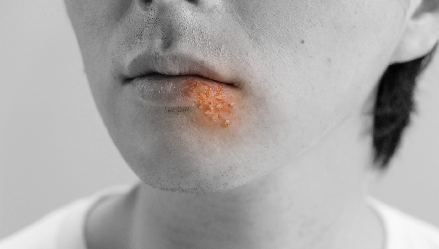 What Does Herpes Look Like? Symptoms and Visual Guide