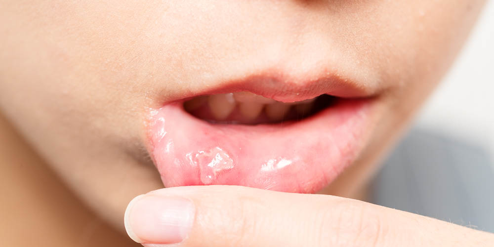 Understanding The Connection Between Oral Health And STDs Symptoms 