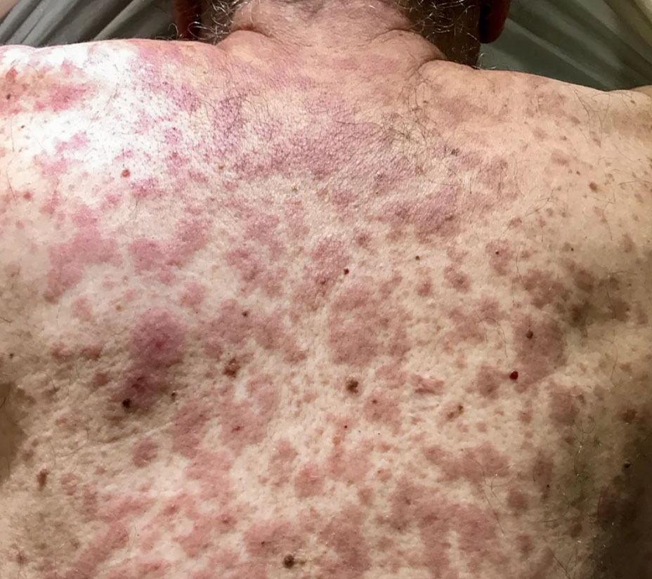 What Does an HIV Rash Look Like?